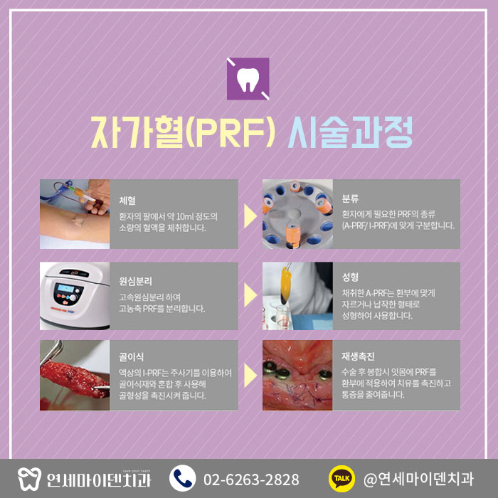 임플란트 뼈이식 (5).jpg