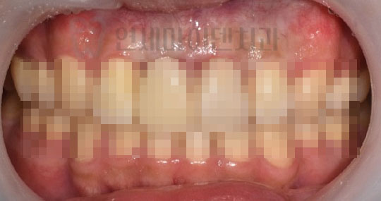 임플란트교정_005.jpg