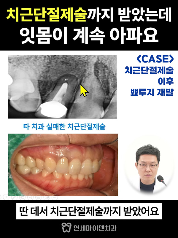 질문4_치근단재수술_admin.jpg