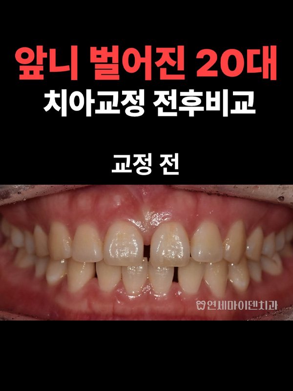 교정케이스20_admin_03.jpg