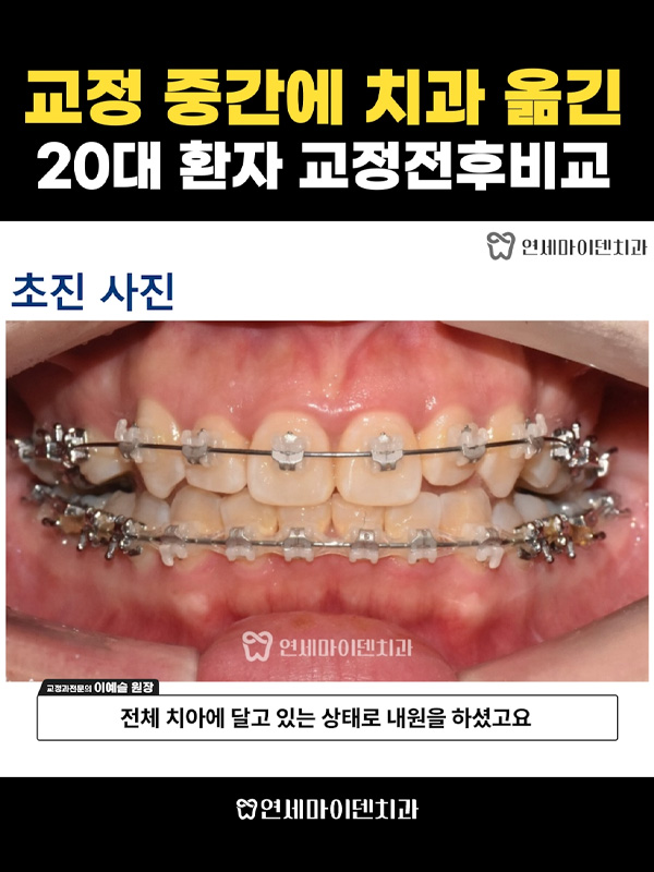 교정케이스17_admin_02.jpg
