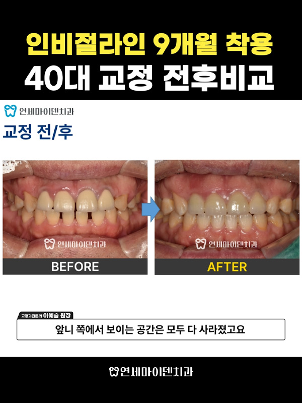 교정케이스16_admin_02.jpg
