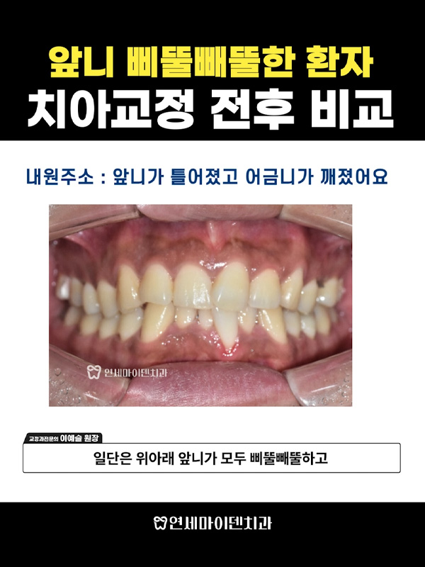교정케이스15_admin_02.jpg