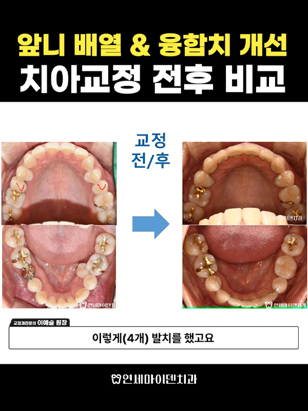 교정케이스14_admin_02.jpg