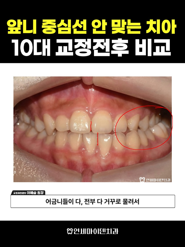 교정케이스12_admin_02.jpg