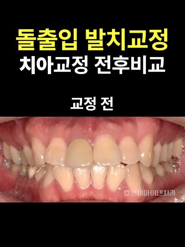 교정케이스25_admin_3.jpg